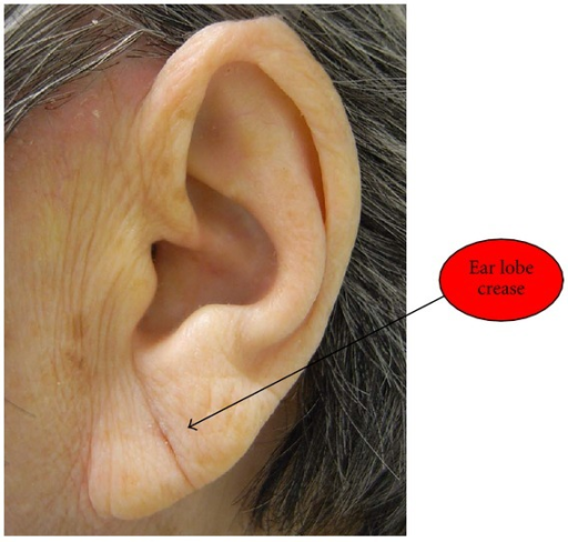 ear lobe crease