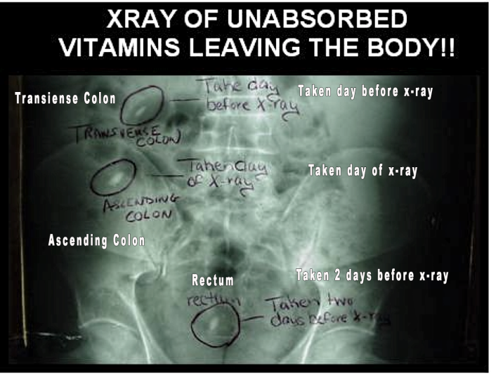 Photo of an x-ray taken of a person's colon area with the vertebrae of their backbone off to one side which clearly shows two supplement tablets, still intact.Take high quality supplements. 